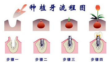 [福州]年龄大了牙齿缺失严重，种植牙是优选？