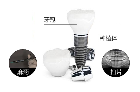 种植牙被称为“人类的第三幅牙齿”不是没有理