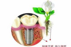 种植牙的费用大概是多少钱？