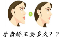 福州牙齿矫正一般需要多长时间能完成？