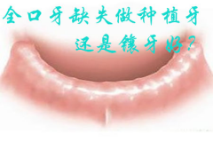 全口牙缺失做种植牙还是镶牙好？