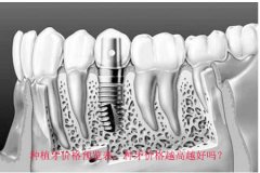 种植牙价格预览表，种牙价格越高越好吗？