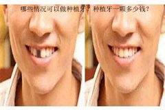 哪些情况可以做种植牙？种植牙一颗多少钱？