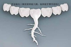 牙齿缺失三颗需要种植几颗，做种植牙费用高吗