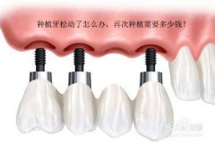 种植牙松动了怎么办，再次种植需要多少钱？