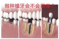 做种植牙会不会很痛？