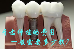 牙齿种植的费用一般需要多少钱？