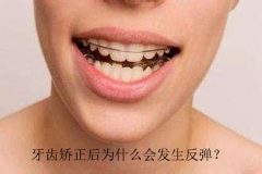 牙齿矫正后为什么会发生反弹？