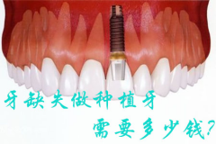 牙缺失做种植牙需要多少钱？