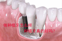 做种植牙怎么样，种植牙真的好吗？