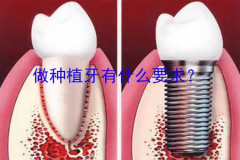 做种植牙有什么要求？