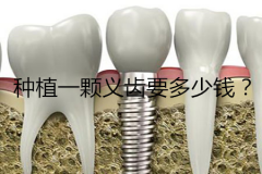 种植一颗义齿要多少钱？种植义齿的价格表