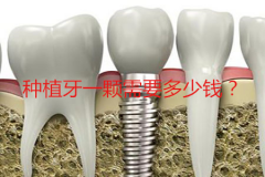 种植牙一颗需要多少钱呢？