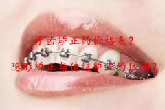 牙齿矫正的价格表，隐形牙齿矫正与传统矫正的