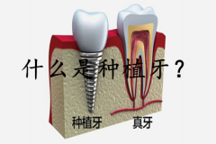 什么是种植牙？有哪些优点？