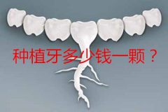 种植牙多少钱一颗？