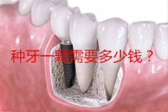种牙一颗需要多少钱？