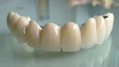如何选择烤瓷牙的种类？