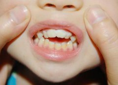 小孩子换牙齿不整齐如何是好？