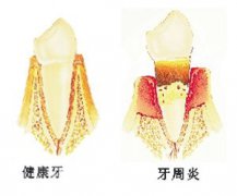 牙周炎如何治疗？