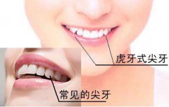 虎牙正确的矫正方式