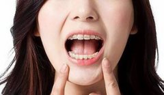 牙齿不齐怎样才能矫正好？
