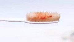 牙龈出血的危害以及治疗方法