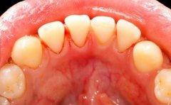 福州科尔教你在生活中解决牙周炎的3种方法