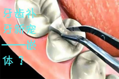 福州牙齿补牙新宠——嵌体