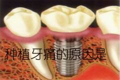 【福州】为什么在种植牙两年之后疼痛？