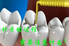 福州补牙会痛吗？补牙的过程需要注意哪些方面