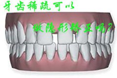 【福州】牙齿稀疏可以做隐形矫正吗？