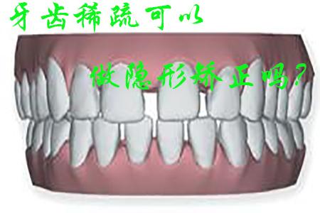 [福州]牙齿稀疏可以做隐形矫正吗？
