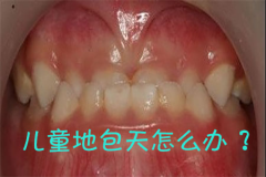 福州儿童地包天怎么办，什么时候可以做矫正？
