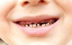 有哪些方法治疗儿童蛀牙呢?