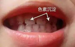 如何预防色素牙？