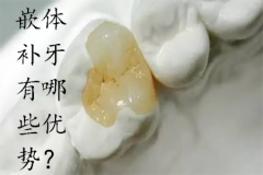 嵌体补牙有哪些优势？