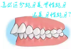 怎么区分龅牙是骨性龅牙还是牙性龅牙？