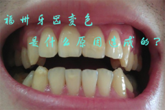 福州牙齿变色是什么原因造成的？