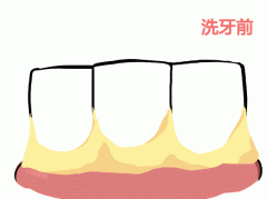 洗牙会使牙齿变松吗