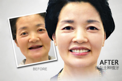 【福州】什么是人工种植牙？种植牙适合哪些人
