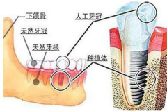 【福州】即刻种植牙的条件？种植牙怎么保养？