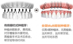 【福州】种植牙为什么偏爱选全颌Multi即刻种牙