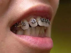 【福州】成人牙齿矫正怎么做？整牙大概要花多