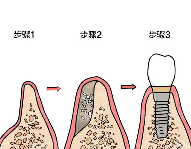 要做种植牙首先得有什么条件？