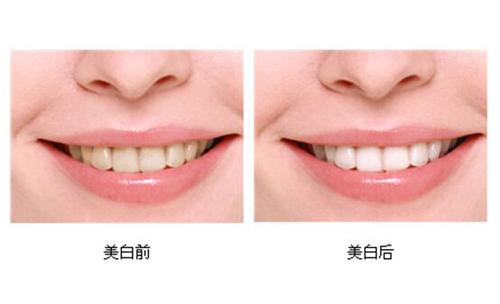 【福州】什么是冷光美白？做冷光美白需要注意