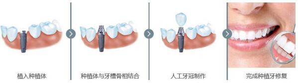 【福州】牙齿缺失了选种植牙真的会比其他办法