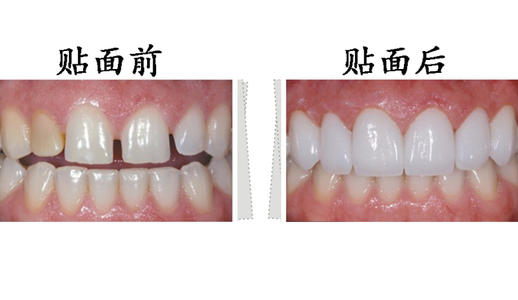 【福州】做牙齿贴面选哪一种比较好？