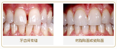 【福州】有什么办法能对前牙进行快速的修复呢