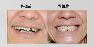 【福州】种植牙会是您镶牙的新选择吗？